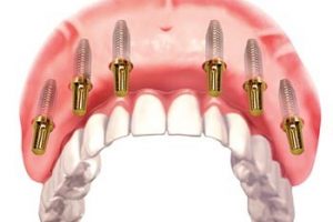 Rehabilitación con 6 implantes y funda