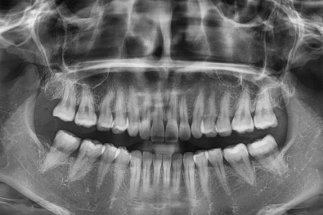 ortopantomografia Ejemplo de ortopantomografía