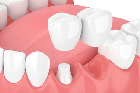 protesis-dental-fija Prótesis dental fija