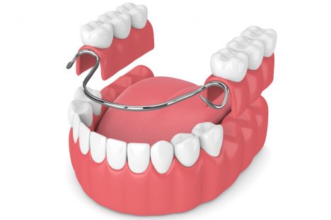 protesis_dental_cuerpo Prótesis dental removible