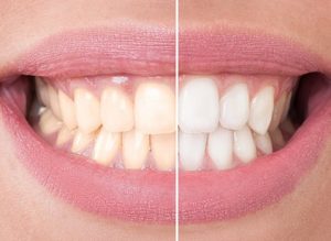 Blanqueamiento dental