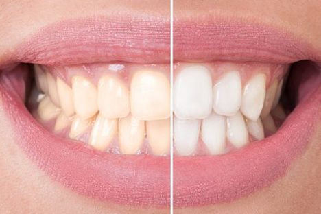tratamiento-blanqueamiento-dental Blanqueamiento dental